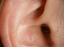 Kiến làm tổ trong…. tai thiếu nữ 16 tuổi!