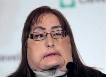 Kinh ngạc với những ca cấy ghép mặt gây chấn động thế giới