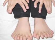 Những bàn tay, bàn chân "quái đản" nhất quả đất