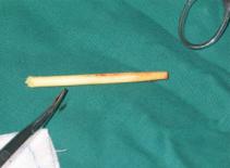 Nam sinh ngậm đũa, sơ ý bị xuyên thủng cằm