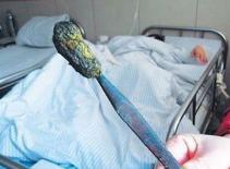 Bàn chải đánh răng nằm trong ổ bụng suốt 25 năm