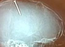 Đinh 10cm xuyên đầu vẫn sống 