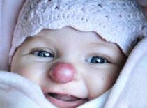 Cô bé có 'mũi cà chua'