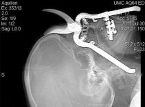 May mắn sống sót khi bị kéo đâm xuyên đầu