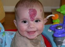 Cắt 'sừng quỷ' cho cậu bé người Anh