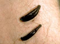 Dùng hàng trăm con đỉa để phẫu thuật khôi phục khuôn mặt