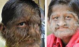 Những người nhiều lông kỳ lạ nhất thế giới