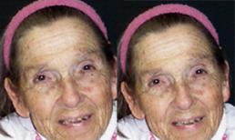 Kỷ lục thế giới: Cụ bà bị liệt sống lâu nămnhất