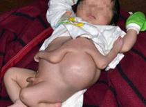 Em bé mới sinh có bốn cánh tay