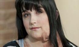 Trải lòng của cô gái có những đám da chảy xệ