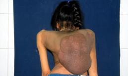 Cô gái Mê Linh và khối u quái!