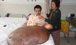Cắt bỏ thành công khối bướu 90kg cho "người chân voi"