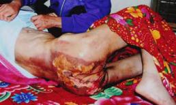 Xót xa người giúp việc kể bị chủ tra tấn