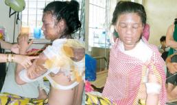 Chồng nhẫn tâm tạt cả nồi nước sôi lên người vợ