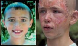 Cõng bà thoát khỏi "bão lửa", người hùng 12 tuổi bỏng nặng