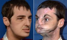 Phẫu thuật thành công ca ghép mặt khó tin