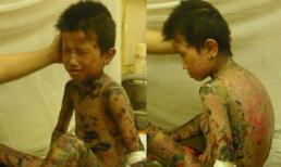 Bé trai 7 tuổi bị tróc da toàn thân như rắn lột