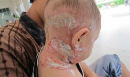 Vụ tạt axit ở Tiền Giang: 3 cháu nhỏ oằn mình trong đau đớn!	