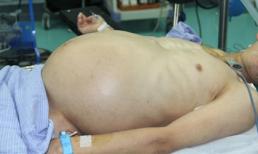 Người đàn ông bỗng nhiên mang... "bụng bầu"