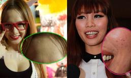 Những làn da 'lởm chởm' mụn, nám của mỹ nhân Việt