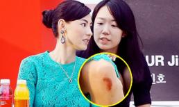 Trương Bá Chi gây chú ý hơn vì vết thương tụ máu ở chân