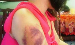 Một nữ sinh tố bị cha hành hung dã man