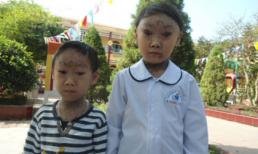 Hai chị em ruột mắc bệnh "mắt ma"