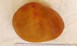 TP.HCM: Sỏi bàng quang nặng gần 1kg