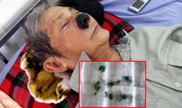 Người đàn ông có cả trăm con dòi trong mũi