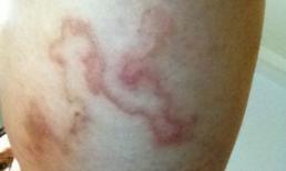  Đi đắp bùn làm đẹp bị nhiễm giun móc chó