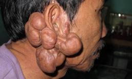 Người đàn ông Quảng Nam có sẹo lồi khắp cơ thể