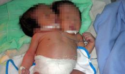 Bé hai đầu ở Sóc Trăng đã tắt thở