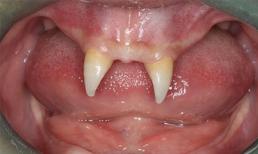 Cậu bé mọc răng như... ma cà rồng