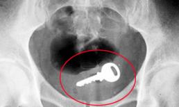 10 vật thể quái dị bị "kẹt" ở... hậu môn