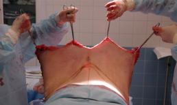 Hãi hùng tận mắt chứng kiến phẫu thuật hút mỡ, căng da bụng