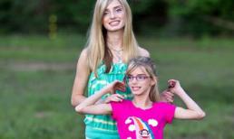 Cặp song sinh dị biệt nhất thế giới