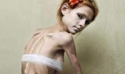 Sốc với bộ ảnh bị biếng ăn 