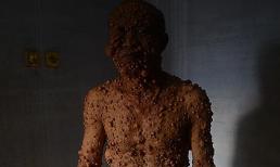 Dựng tóc gáy với người đàn ông 'bong bóng'