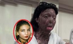 Người phụ nữ tồn tại suốt 12 năm với khuôn mặt 'quái vật'