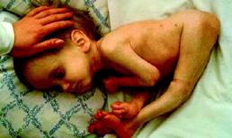 Những em nhỏ dị dạng đáng thương vì nhiễm phóng xạ