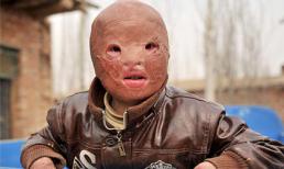 Cậu bé biến thành "người ngoài hành tinh" sau khi bị thiêu cháy