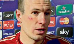 Ribery đấm Robben bầm mặt, Bayern sắp loạn  