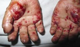 Sự thực về bệnh “ma cà rồng” tại Việt Nam