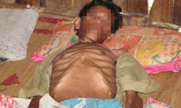 Bệnh lạ ở Quảng Ngãi có thể do ăn gạo mốc.