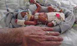 Bé trai sinh ra nhỏ hơn bàn tay sống sót kỳ diệu