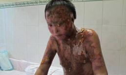 Vụ tạt axit tàn độc: Ám ảnh khôn nguôi 
