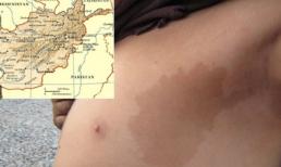 Đổi đời nhờ chiếc bớt hình bản đồ quốc gia