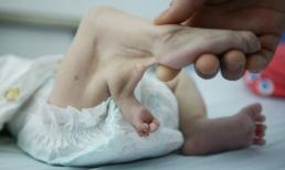 Trung Quốc xuất hiện bé gái 'mọc cựa'