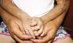 Nỗi khổ bệnh nhân “ma cà rồng” đầu tiên ở Việt Nam