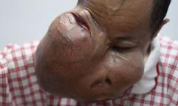 Người đàn ông có khối u... to hơn mặt